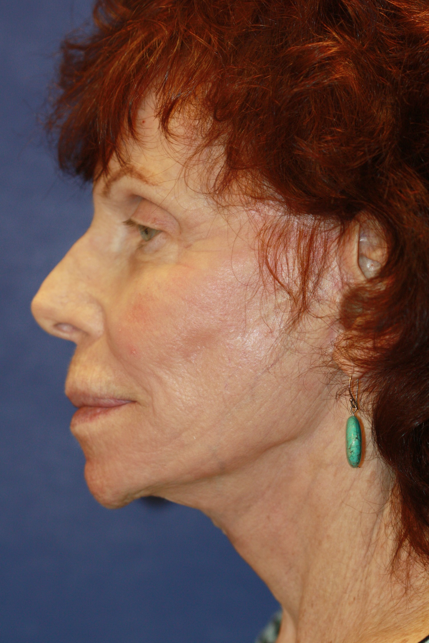 peg after Casey Cosmetic Surgery Facial and Body Surgery
