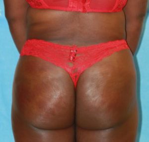 Brazilian Butt Lift After