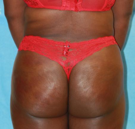 Brazilian Butt Lift After