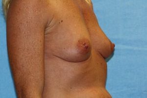 Breast Augmentation Before