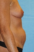 Tummy Tuck Before